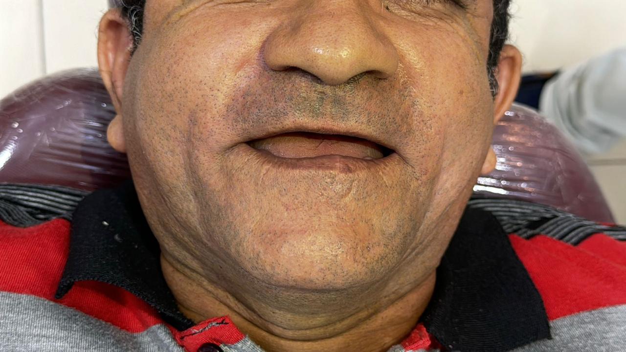 Paciente da Sorria Mais antes do tratamento, sem os dentes superiores