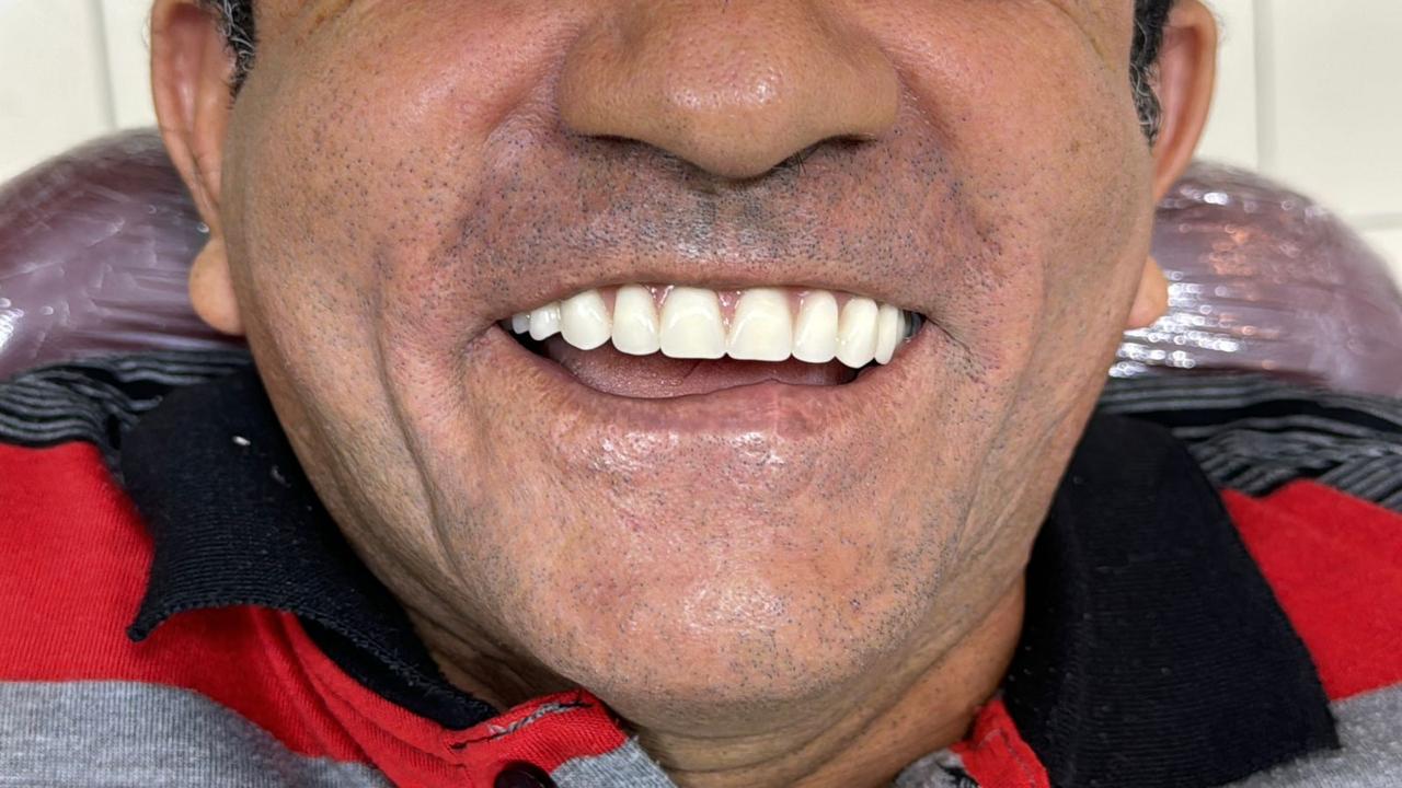 O mesmo paciente sorrindo após o tratamento com prótese feita na Sorria Mais